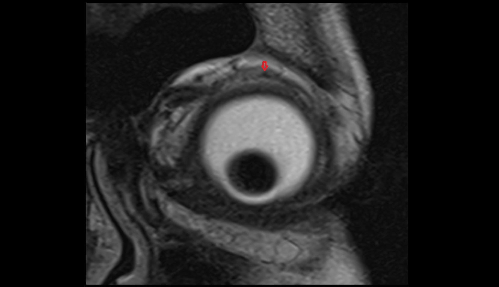 Superior tarsus mri image