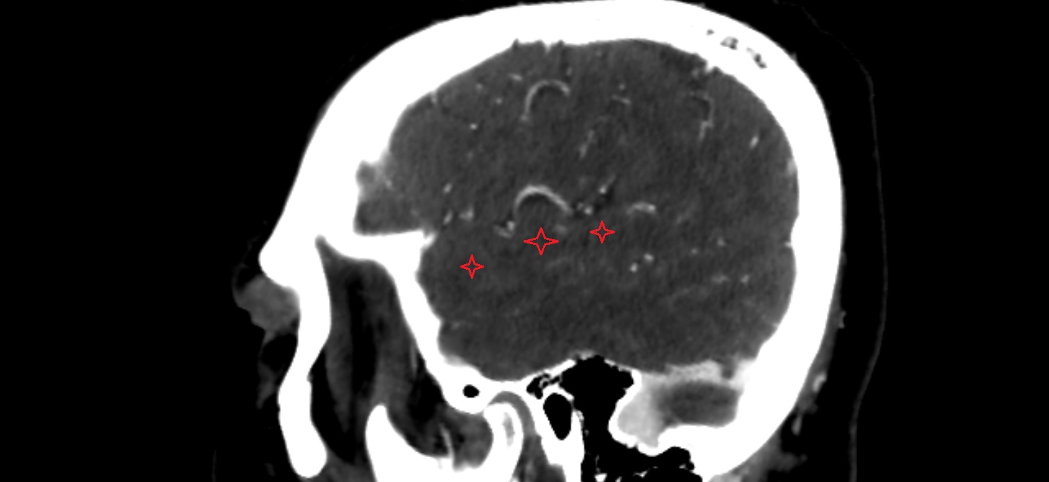 Superior temporal gyrus CT sagittal  cross sectional anatomy radiology image