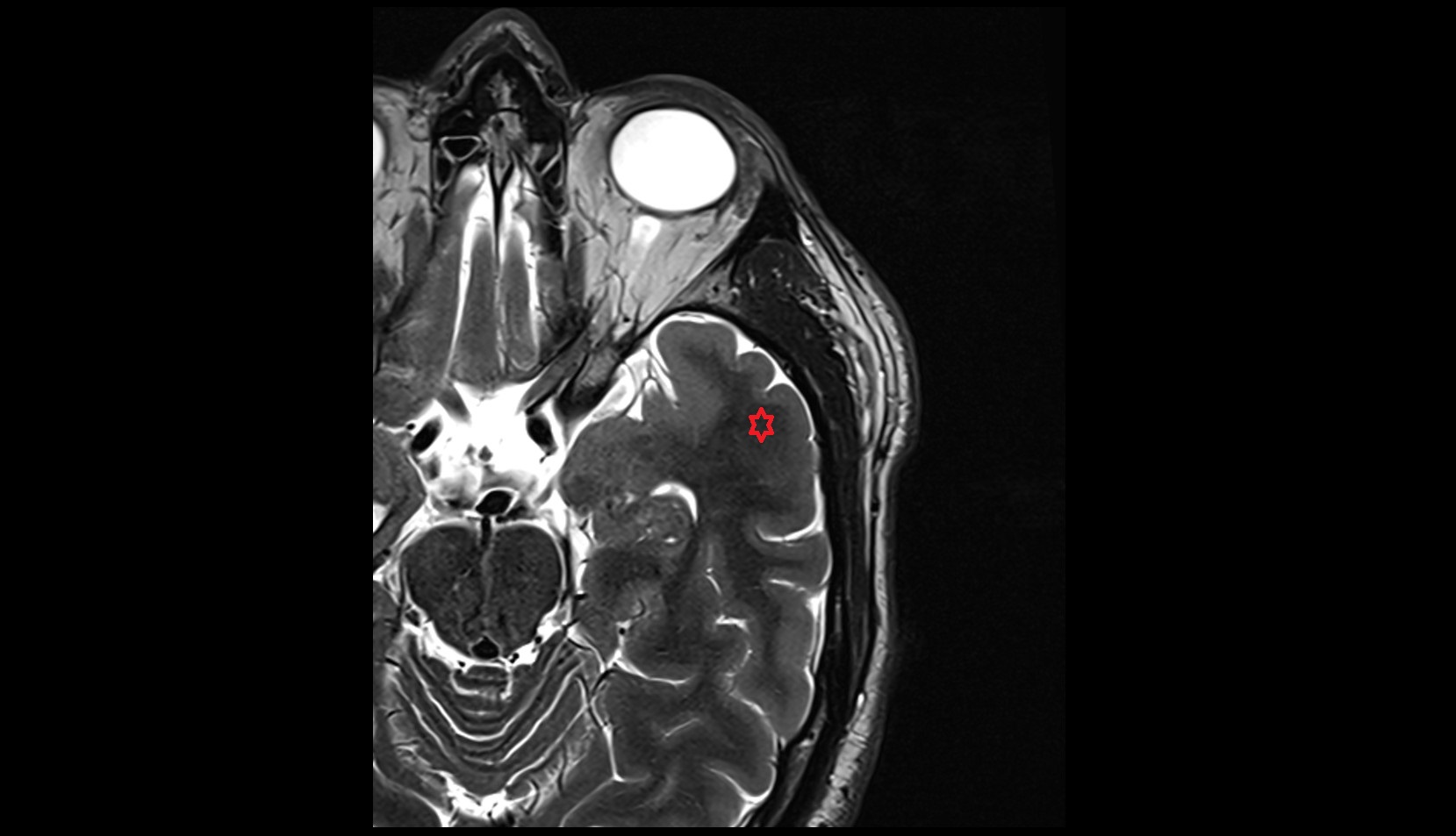 Superior temporal gyrus mri 3t axial image
