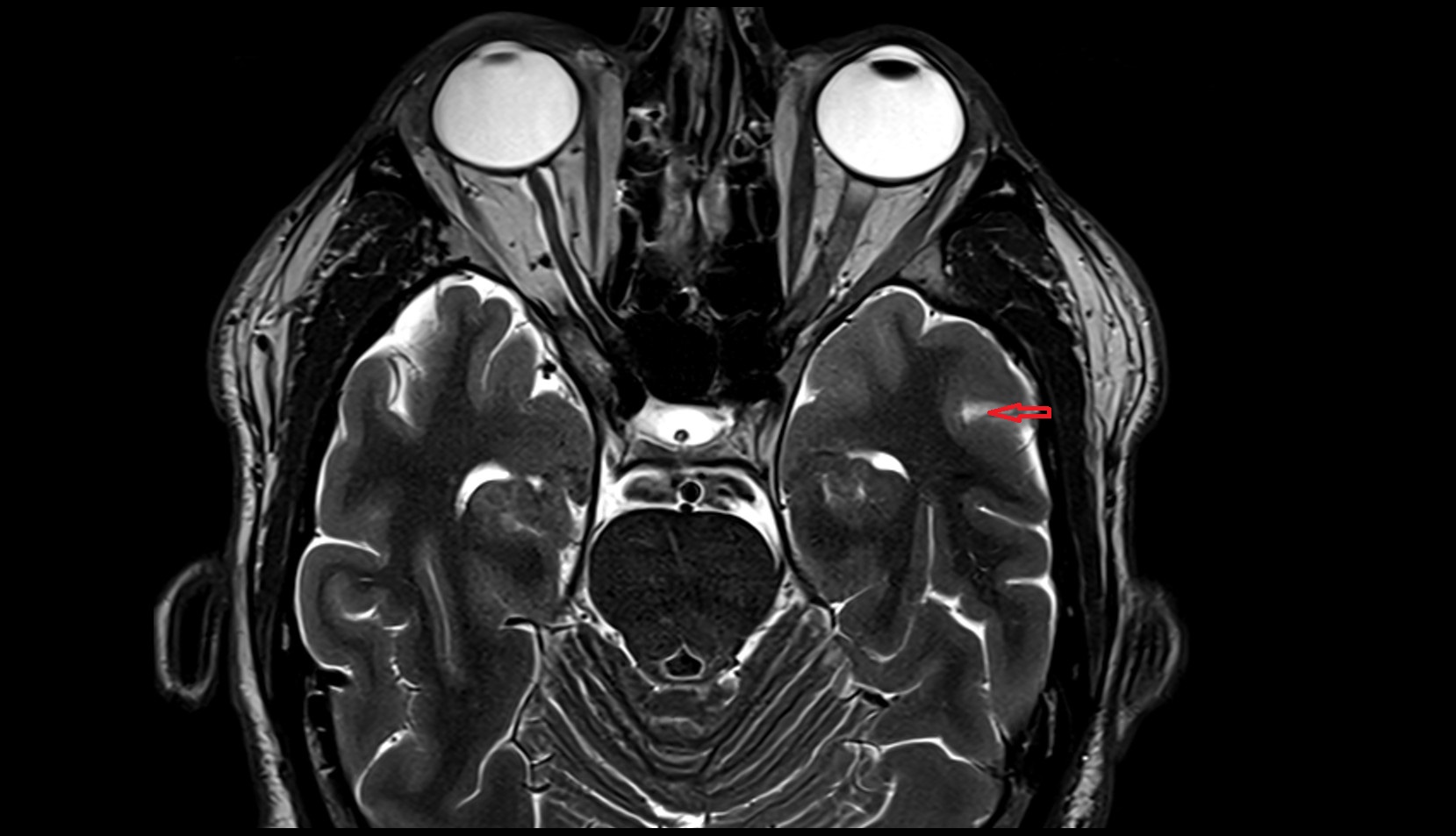 Superior temporal sulcus MRI 3T axial image