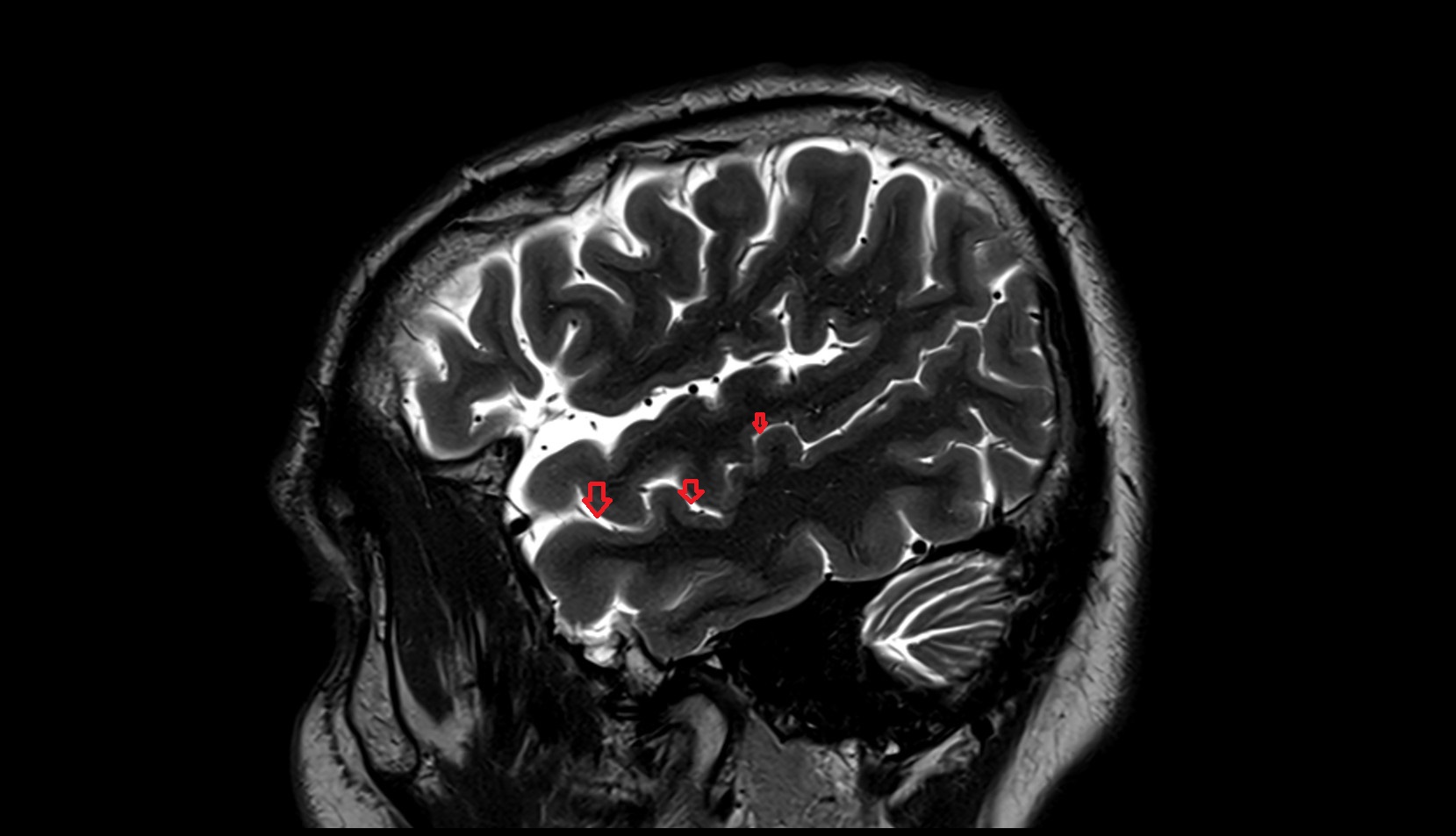 Superior temporal sulcus MRI 3T sagittal image