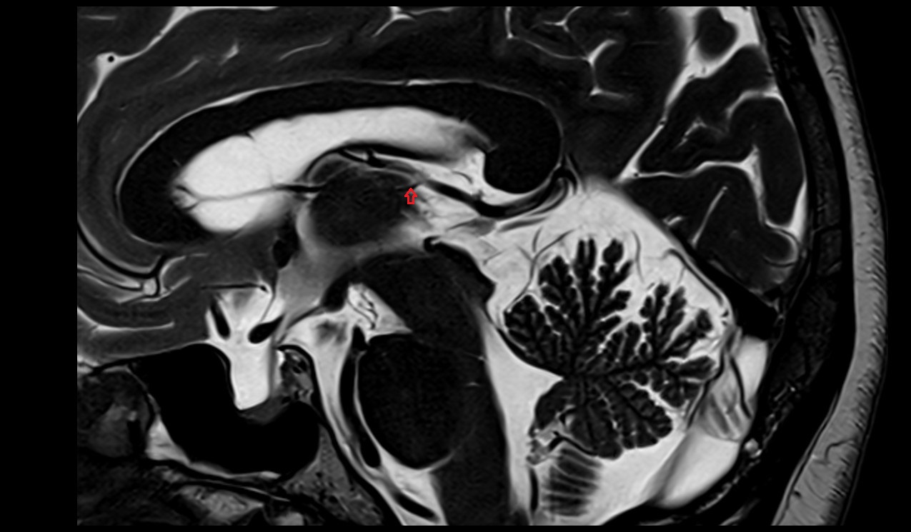 Superior thalamic veins MRI 3T sagittal image