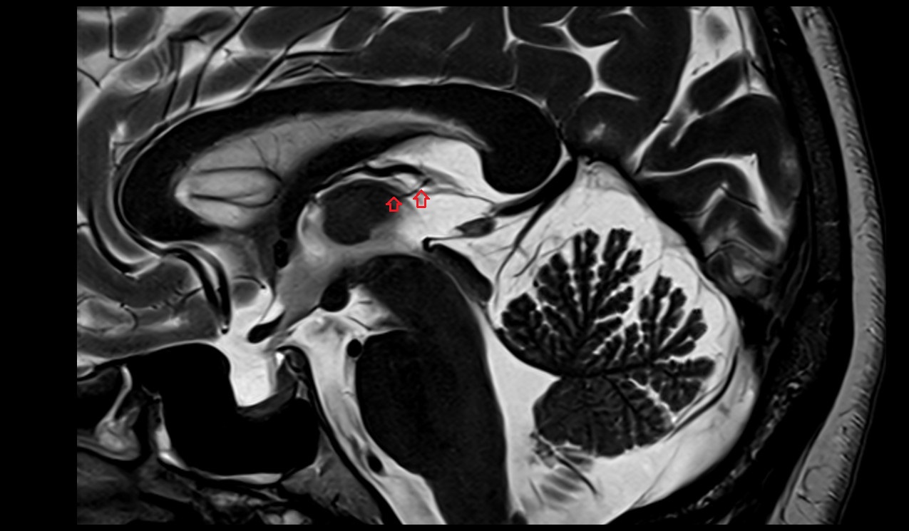Superior thalamic veins MRI 3T sagittal image 1
