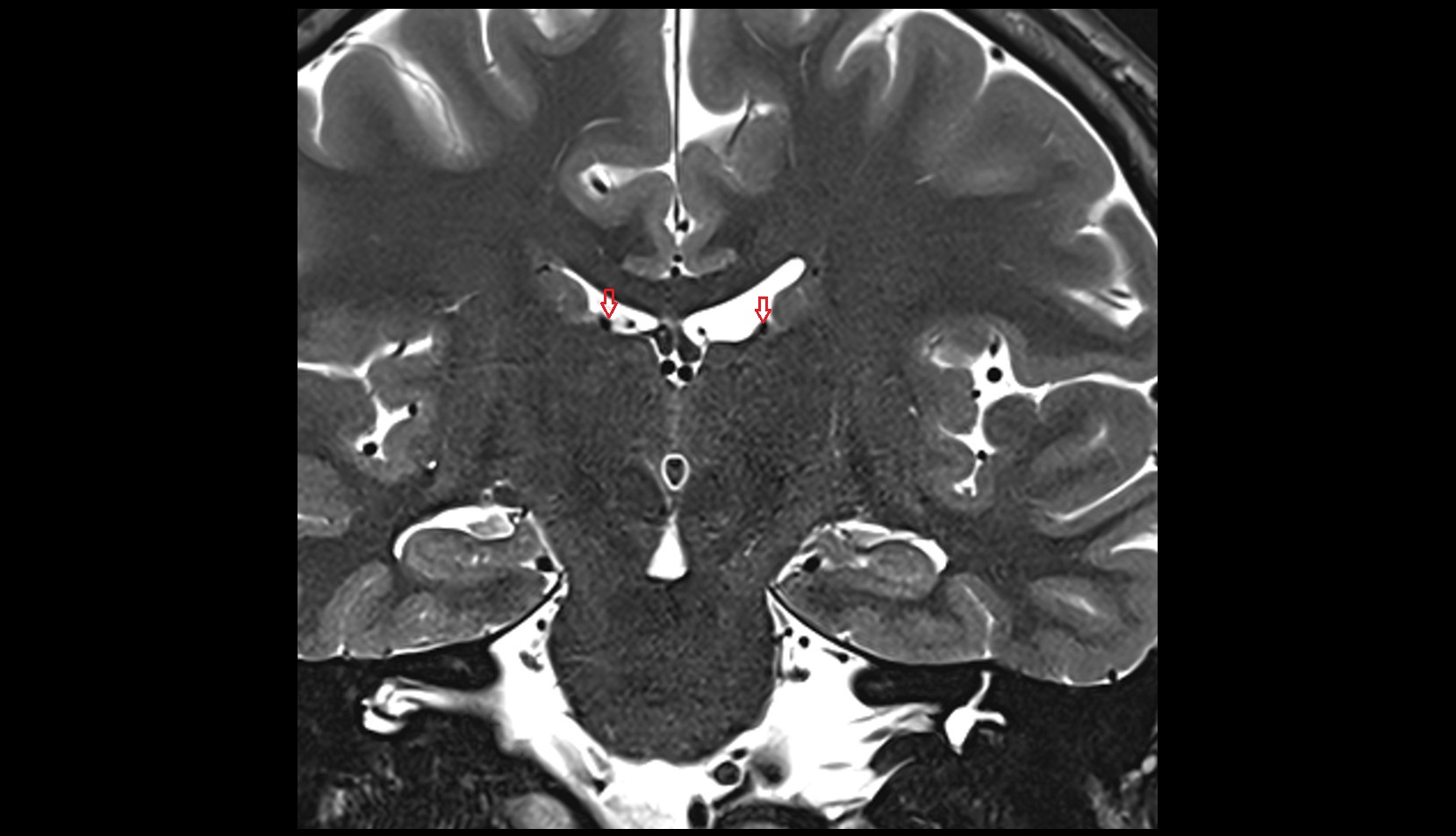 Superior thalamostriate vein MRI 3T coronal image