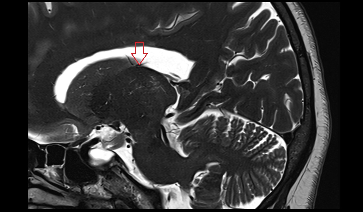 Superior thalamostriate vein MRI  sagittal 3T image