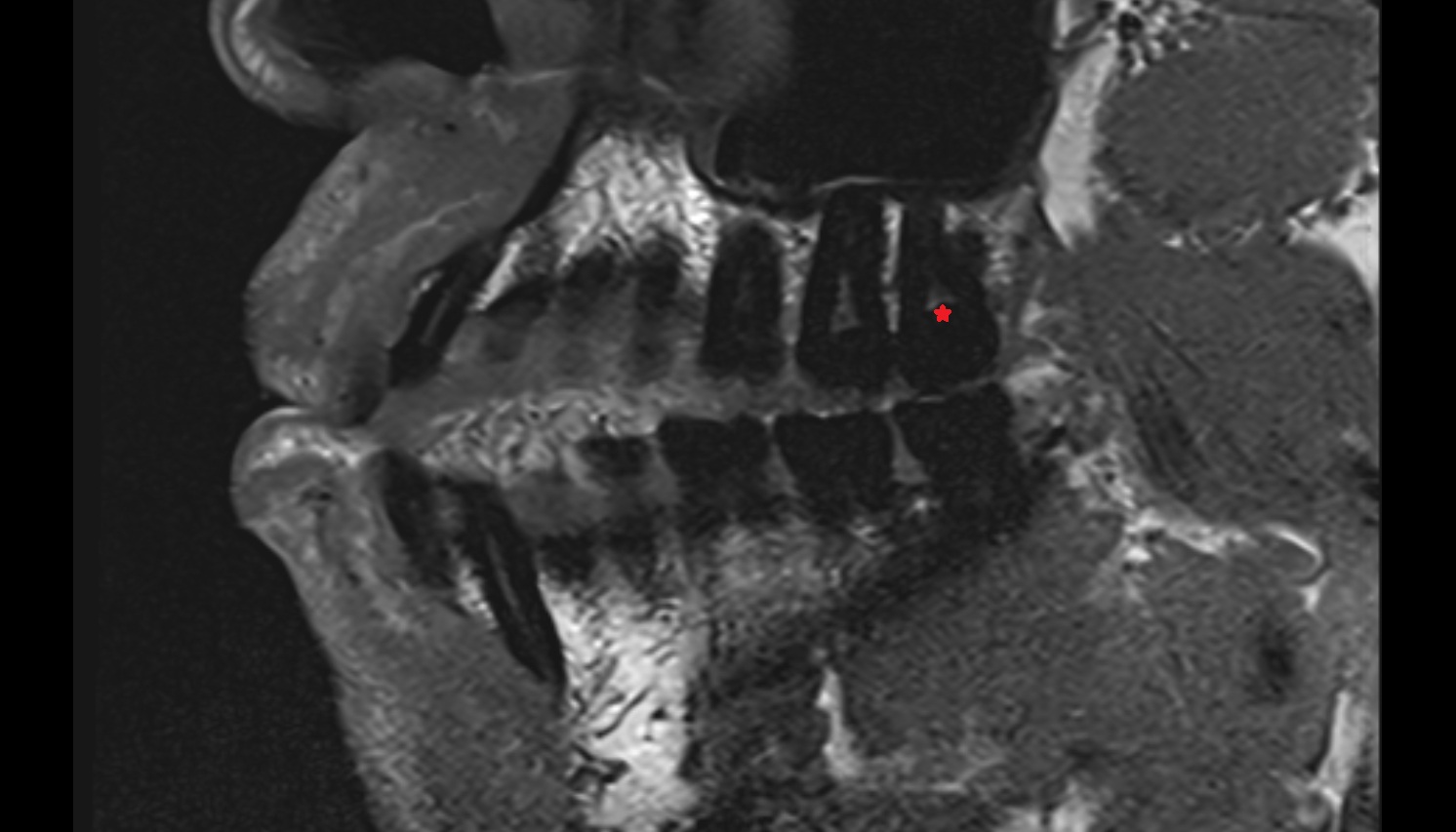 Superior third molar tooth mri sag  image -img-00000-00000