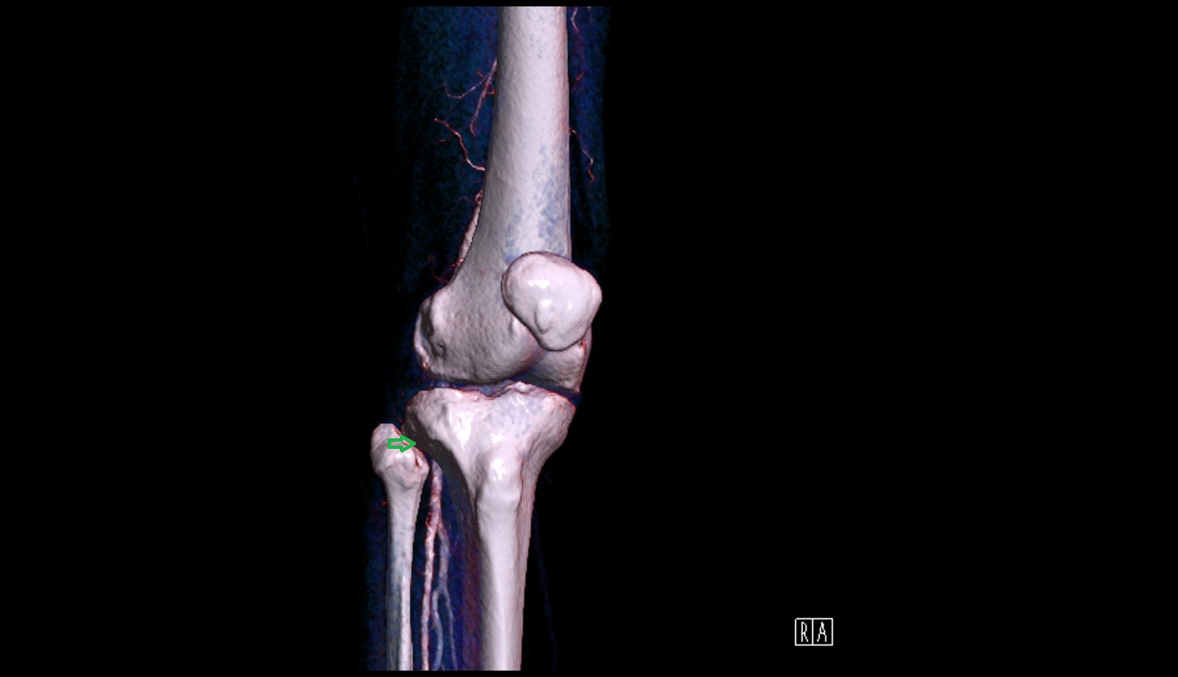 Superior tibiofibular joint 3d