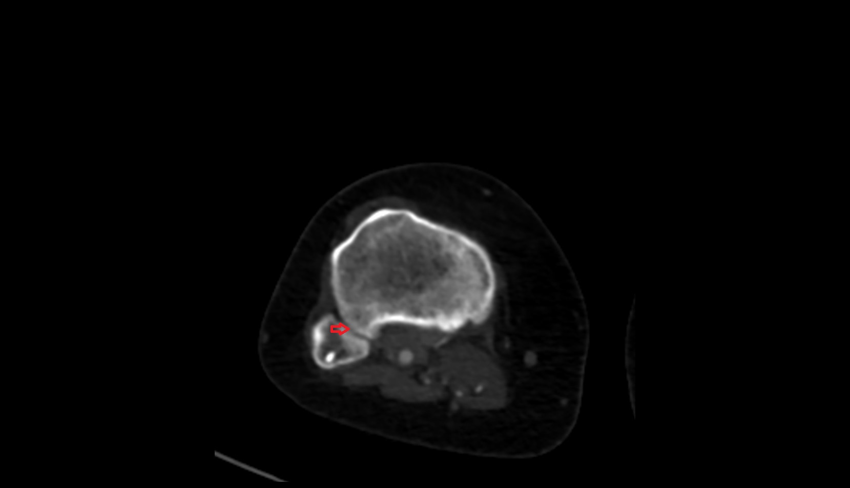 Superior tibiofibular joint ct