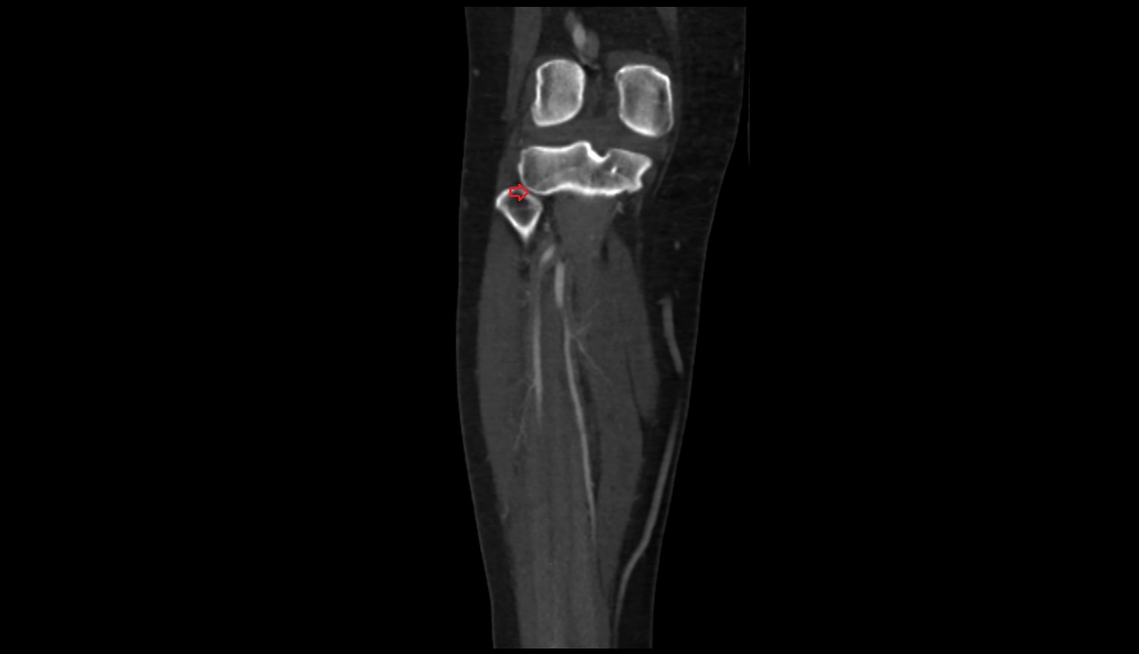 Superior tibiofibular joint ct coronal