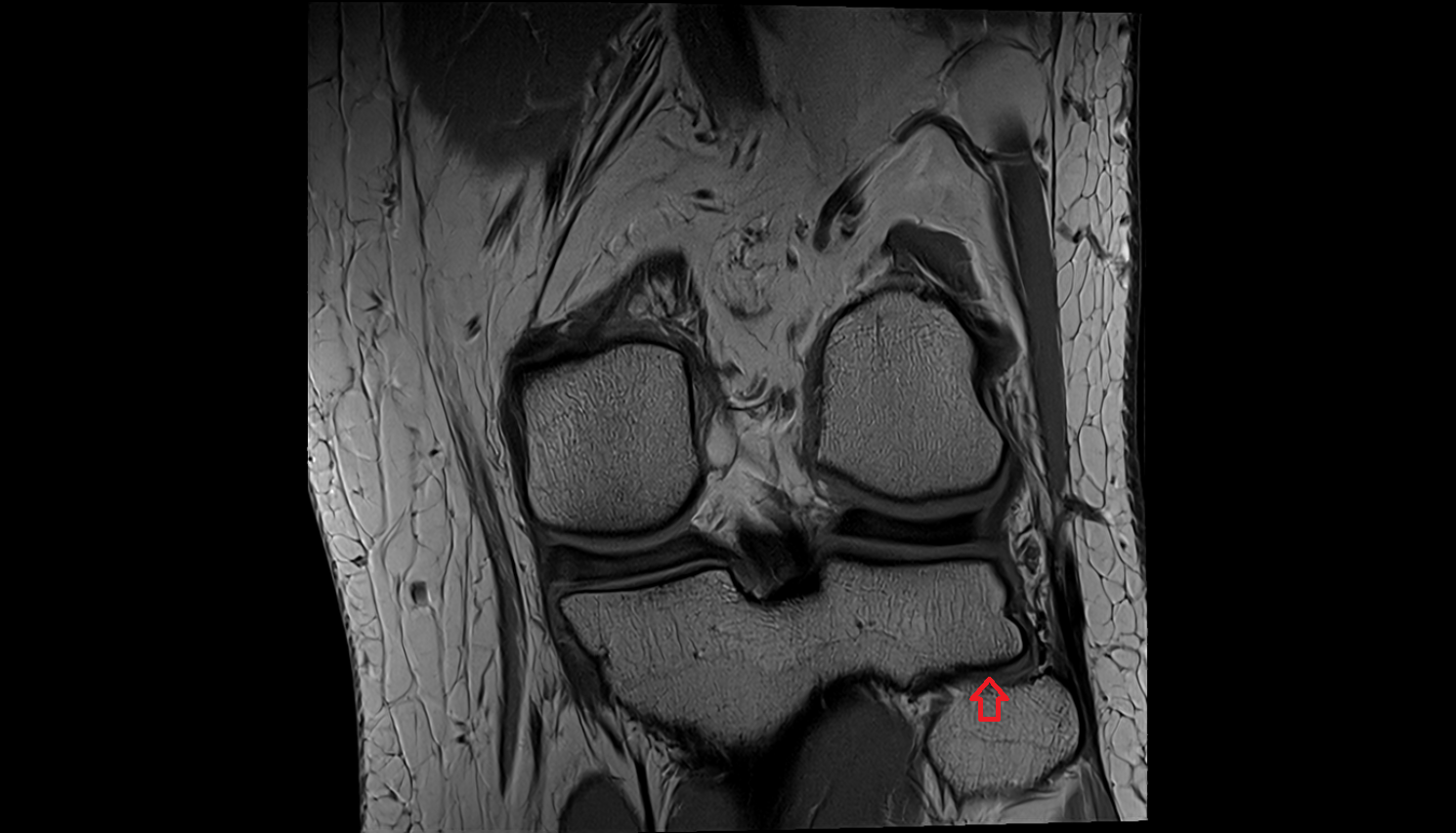 Superior tibiofibular joint  mri  anatomy labelled image-img-00000-00000