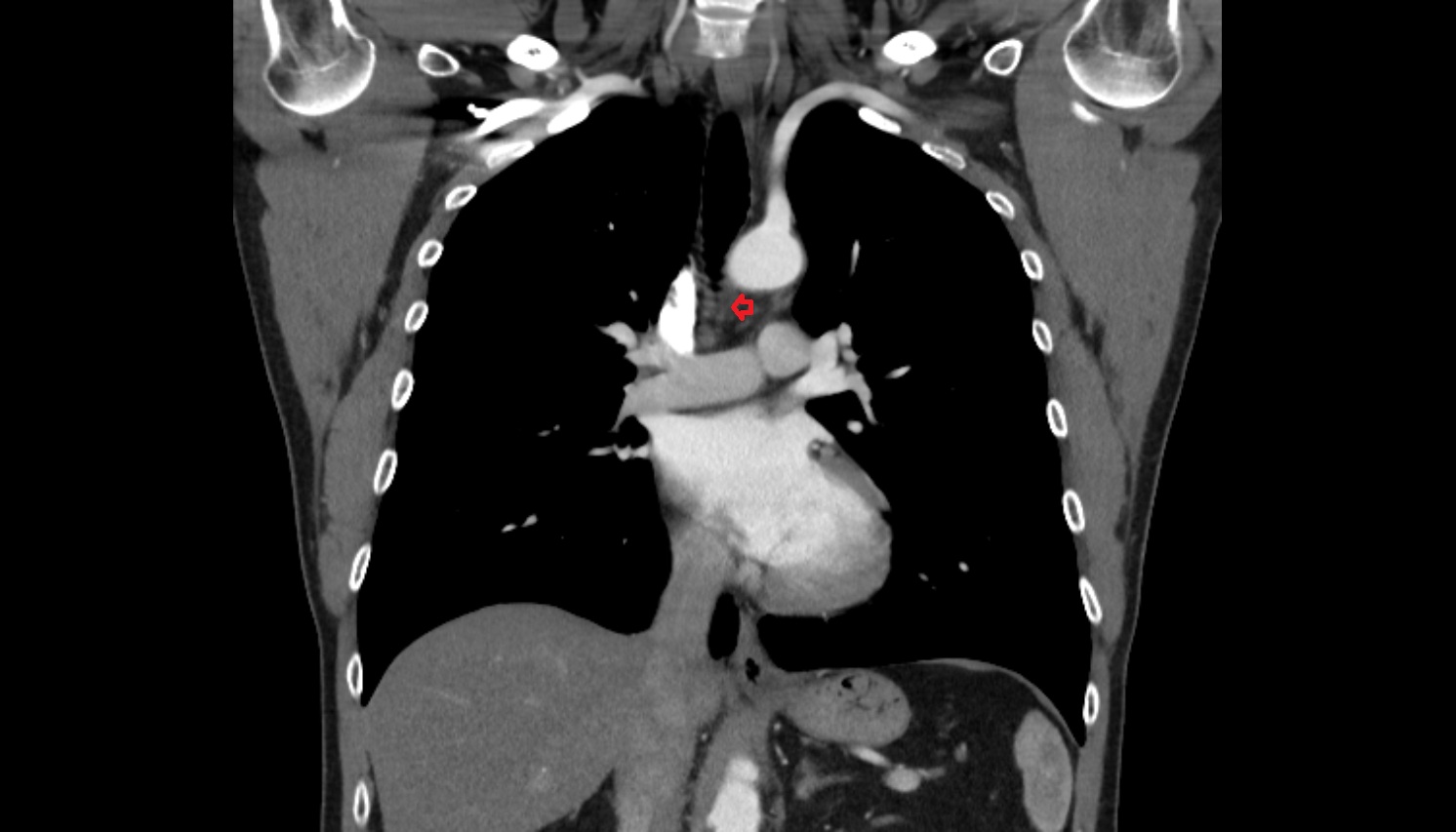 Superior tracheobronchial lymph nodes  anatomy CTi coronal  image -img-00000-00000