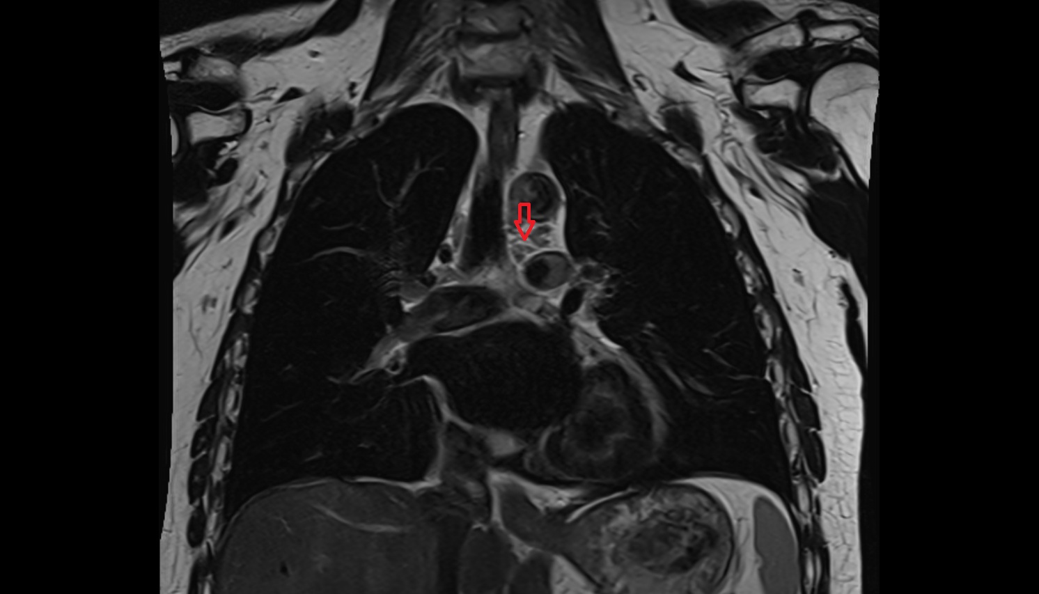 Superior tracheobronchial lymph nodes  anatomy mri coronal  image -img-00000-00000