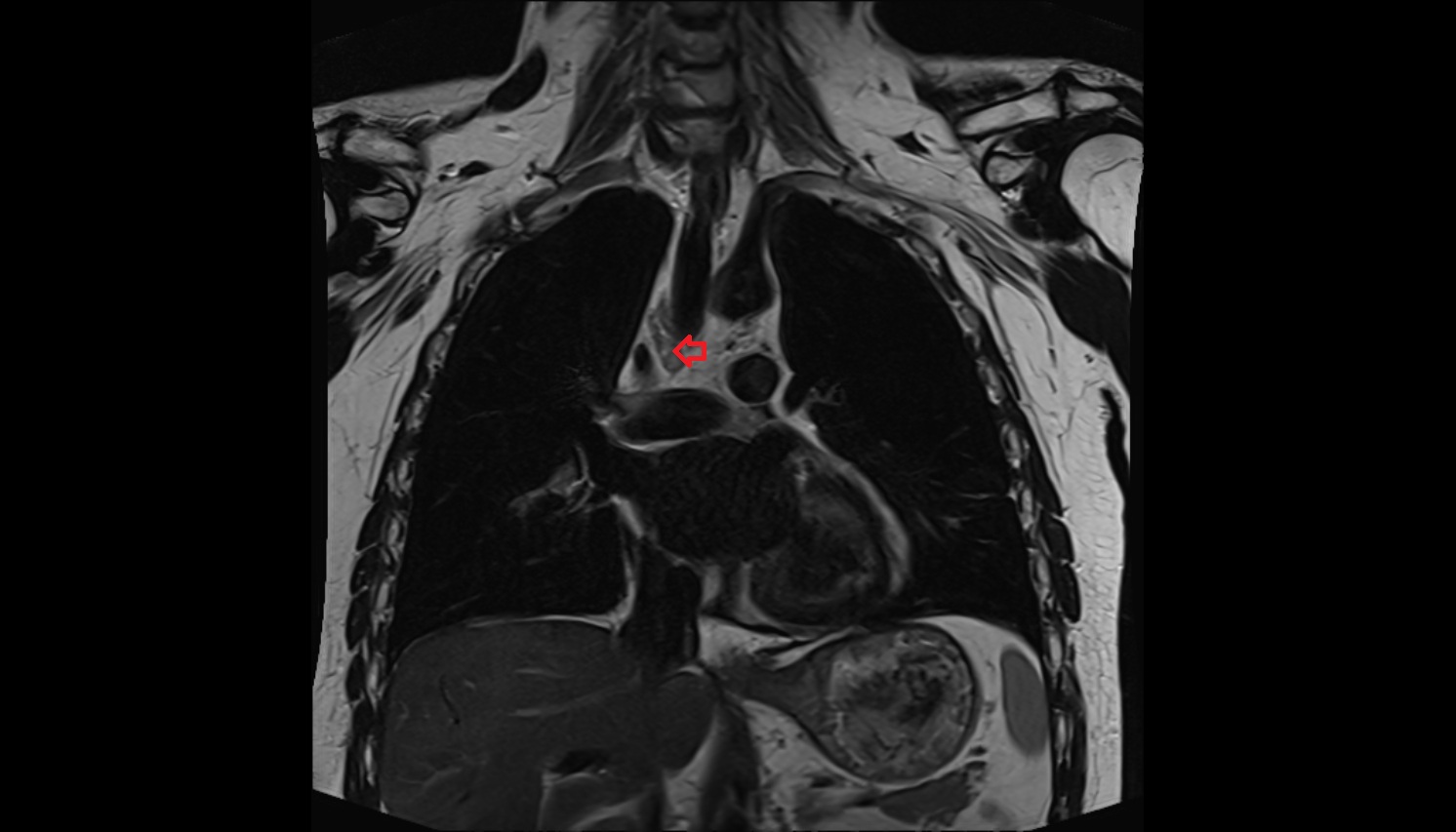 Superior tracheobronchial lymph nodes  anatomy mri coronal  image -img-00000-00000_00001