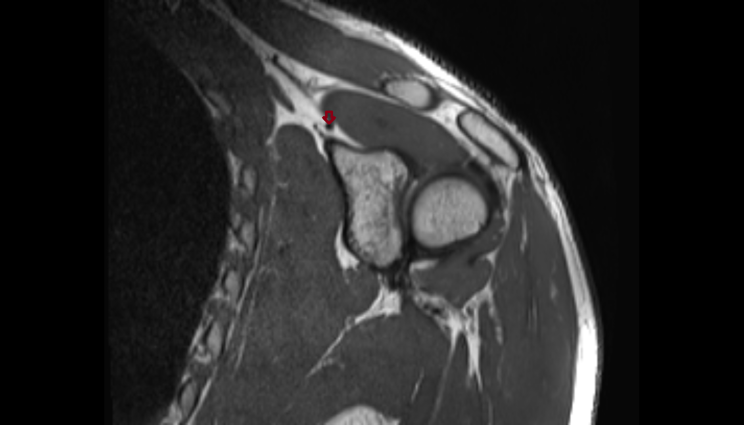 Superior transverse scapular ligament cor cross sectional anatomy 3T MRI AI enhanced radiology image -img-00000-00000