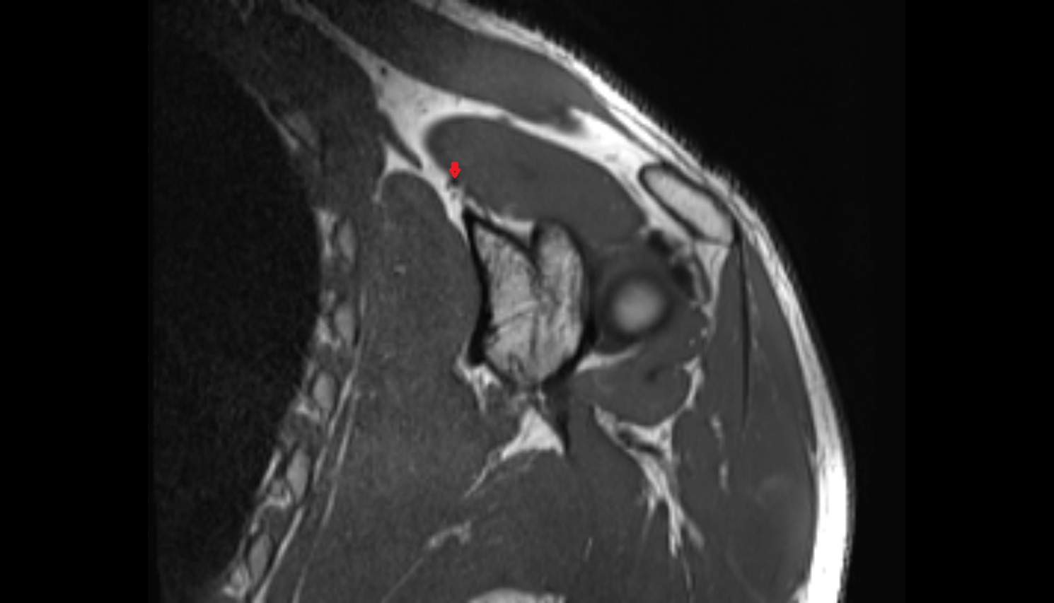 Superior transverse scapular ligament cor cross sectional anatomy 3T MRI AI enhanced radiology image -img-00000-00000_00001