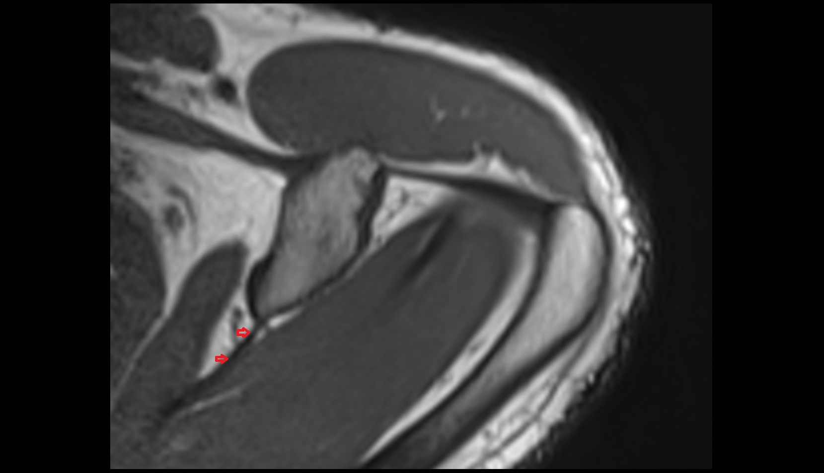 Superior transverse scapular ligament mri axial image