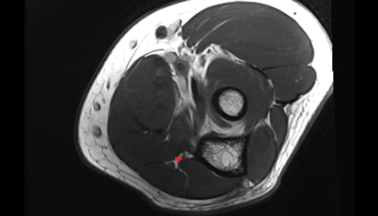 Superior ulnar collateral artery axial cross sectional anatomy 3T MRI AI enhanced radiology image -img-00000-00000