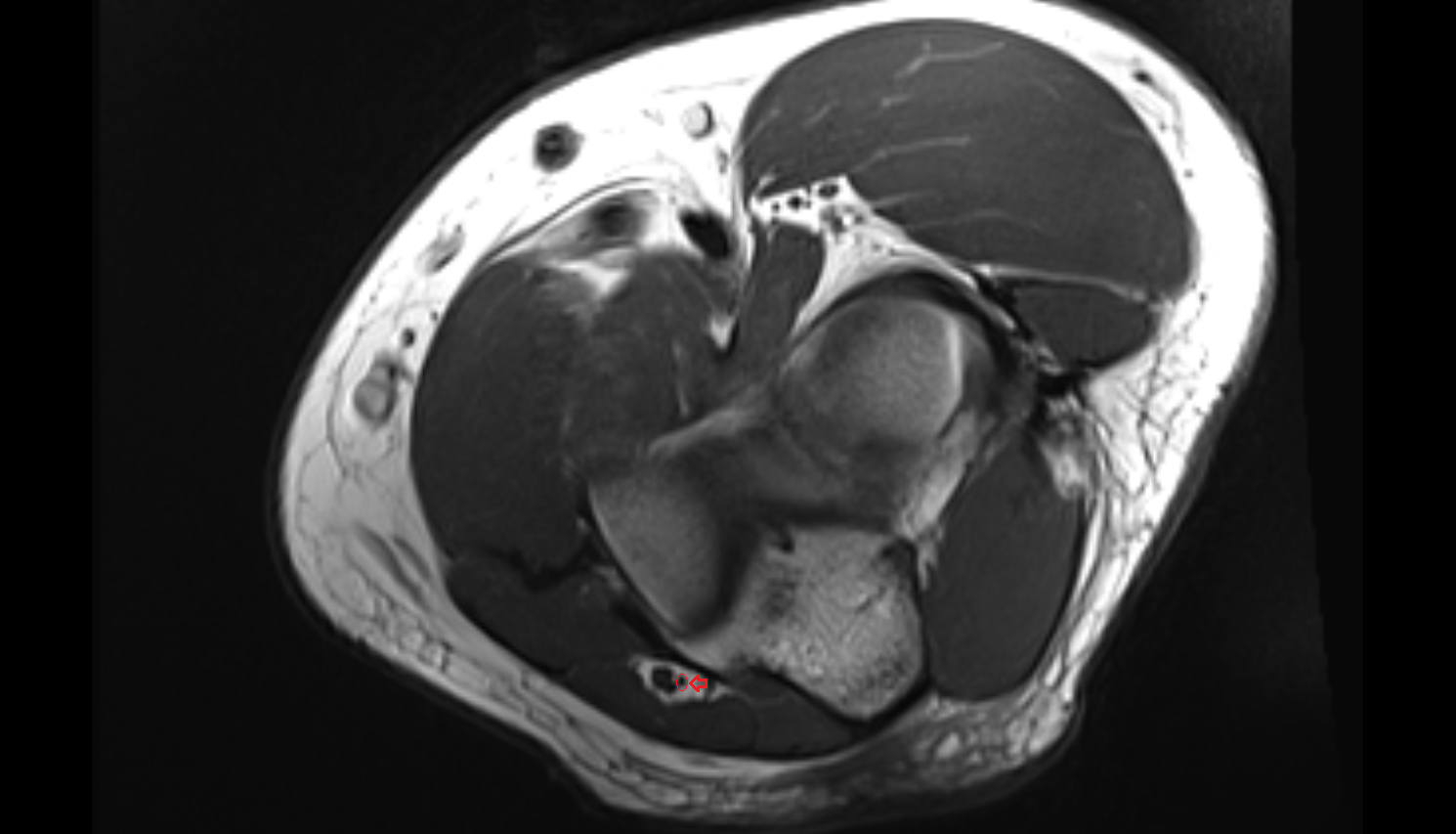 Superior ulnar collateral artery axial cross sectional anatomy 3T MRI AI enhanced radiology image -img-00000-00000_00001
