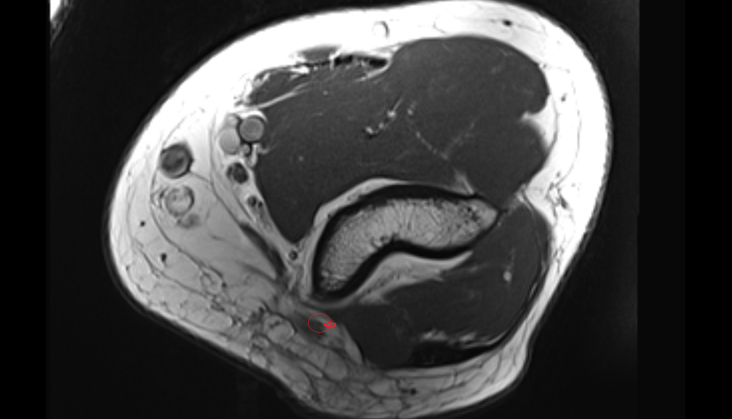 Superior ulnar collateral artery axial cross sectional anatomy 3T MRI AI enhanced radiology image -img-00000-00000_00002