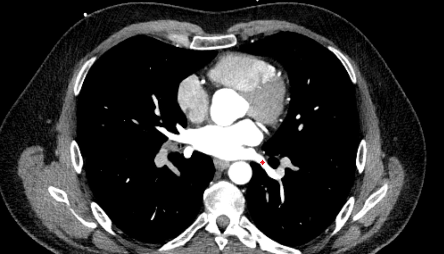 Superior vein of left lung