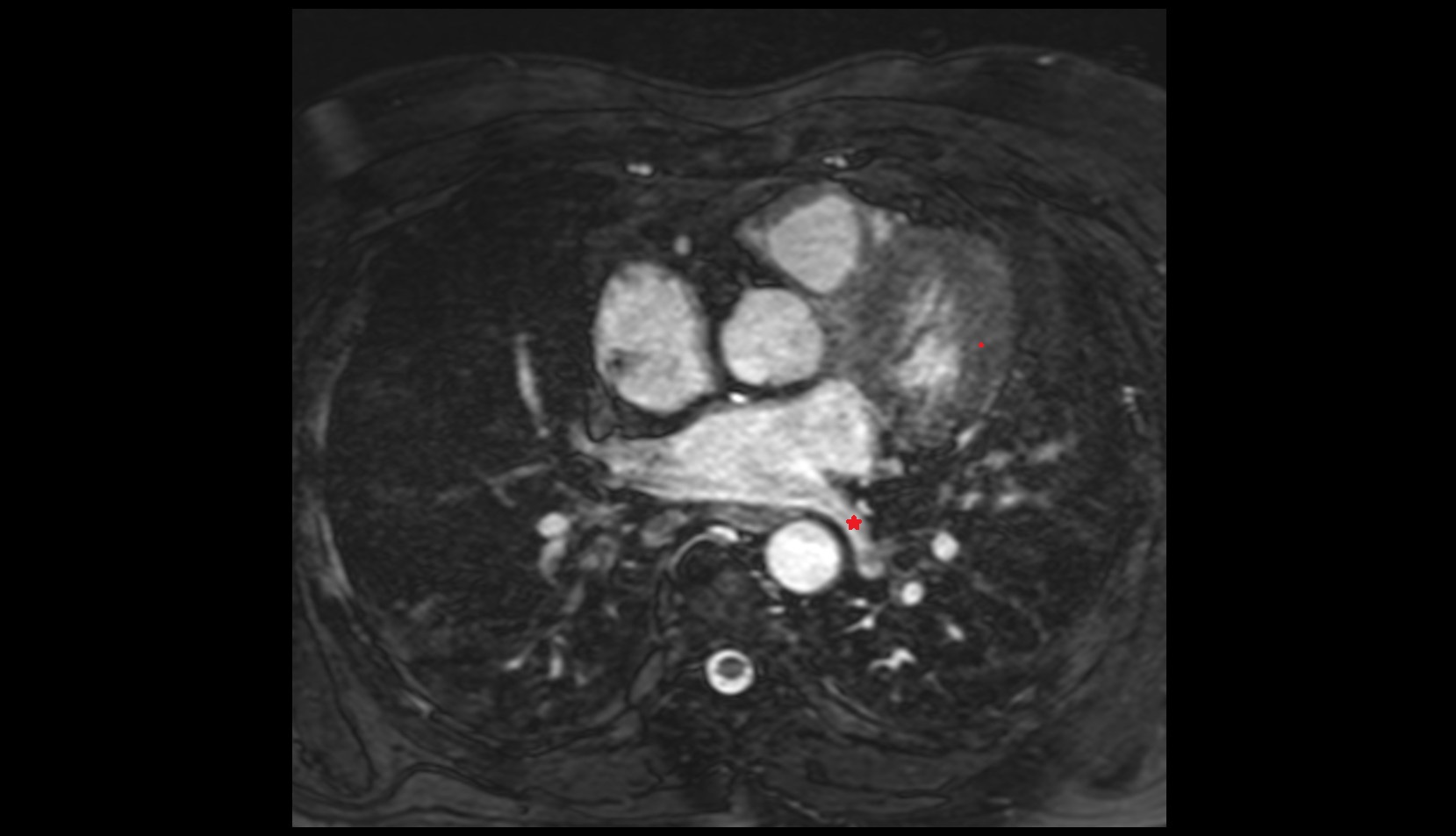 Superior vein of left lung mri image