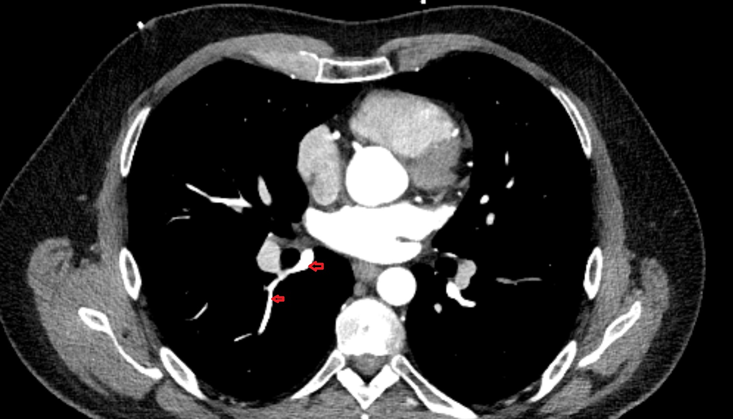 Superior vein of right lung anatomy CT axial  image -img-00000-00000