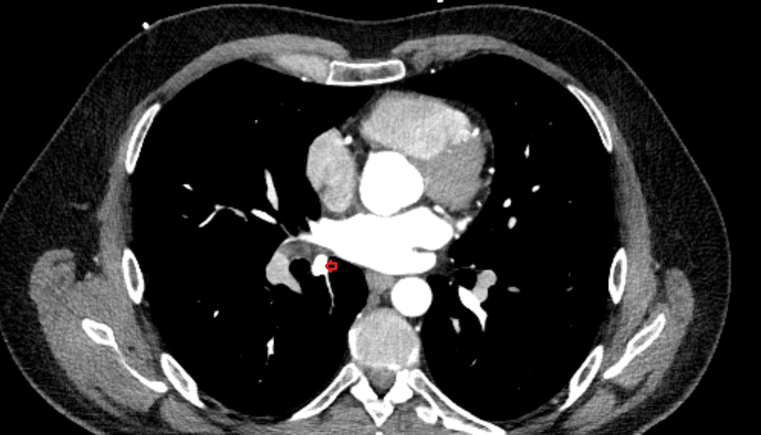 Superior vein of right lung anatomy CT axial  image -img-00000-00000_00001