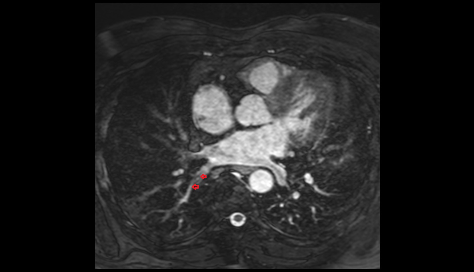 Superior vein of right lung mri image