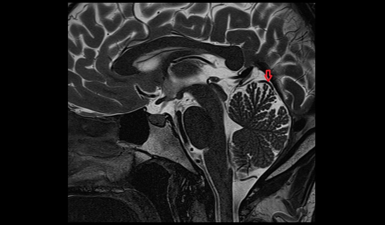 Superior vein of vermis MRI 3T sagittal image