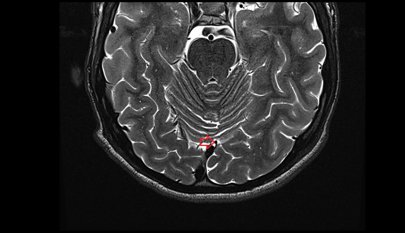 Superior vein of vermis axial mri 3t image1