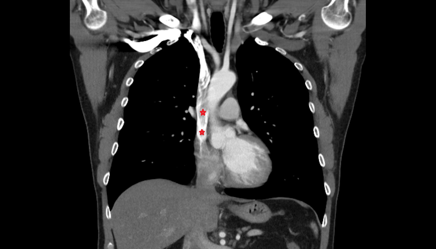 Superior vena cava  anatomy CT CORONAL  image -img-00000-00000