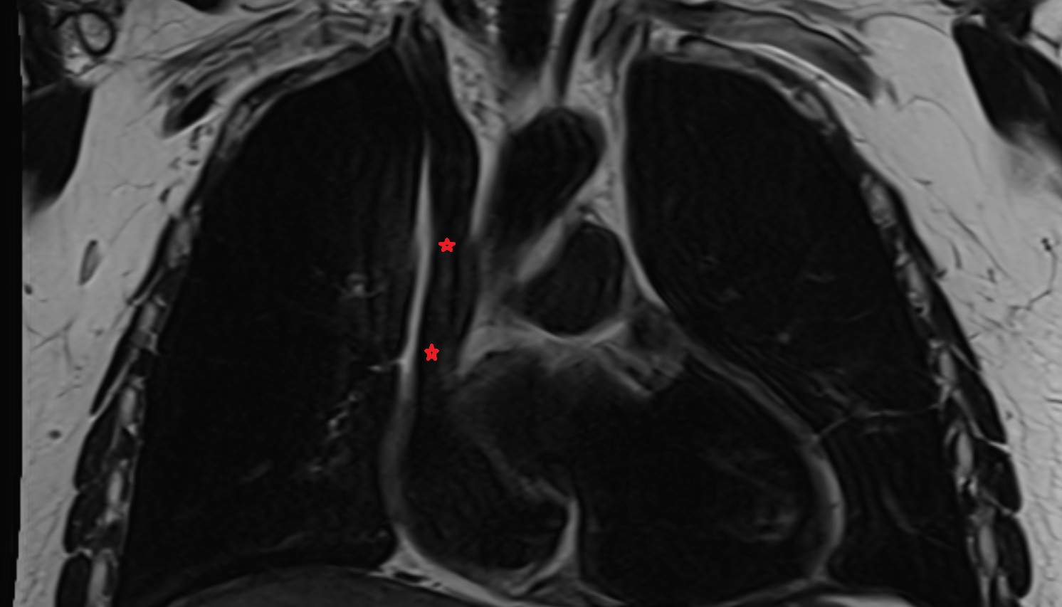 Superior vena cava  anatomy  MRI  CORONAL image -img-00000-00000