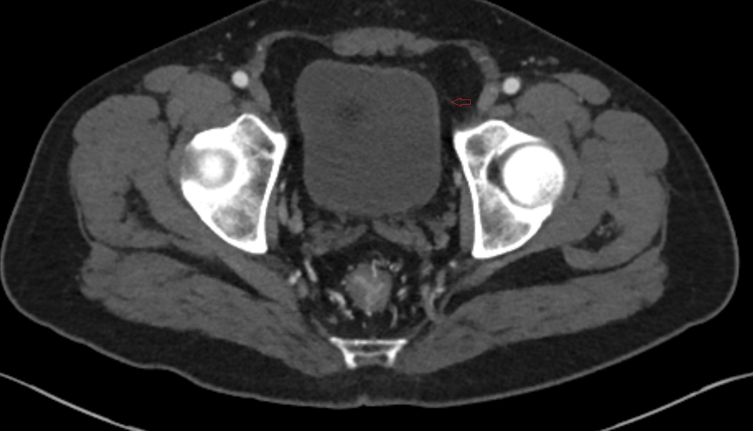 Superior vesical artery  ct axial  image   CT axial anatomy  image-img-00000-00000