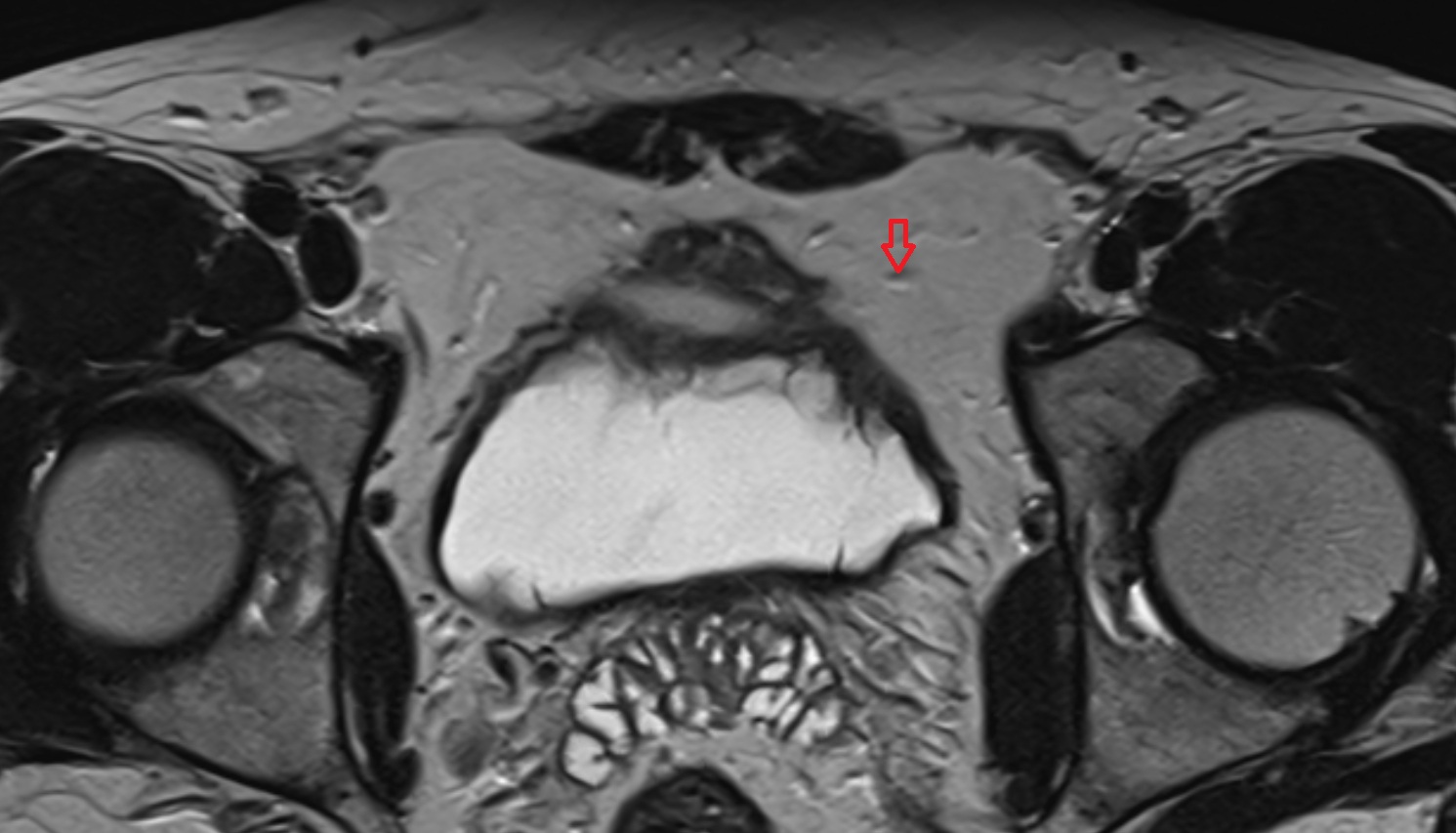 Superior vesical artery  mri axial  image   CT axial anatomy  image-img-00000-00000_00001