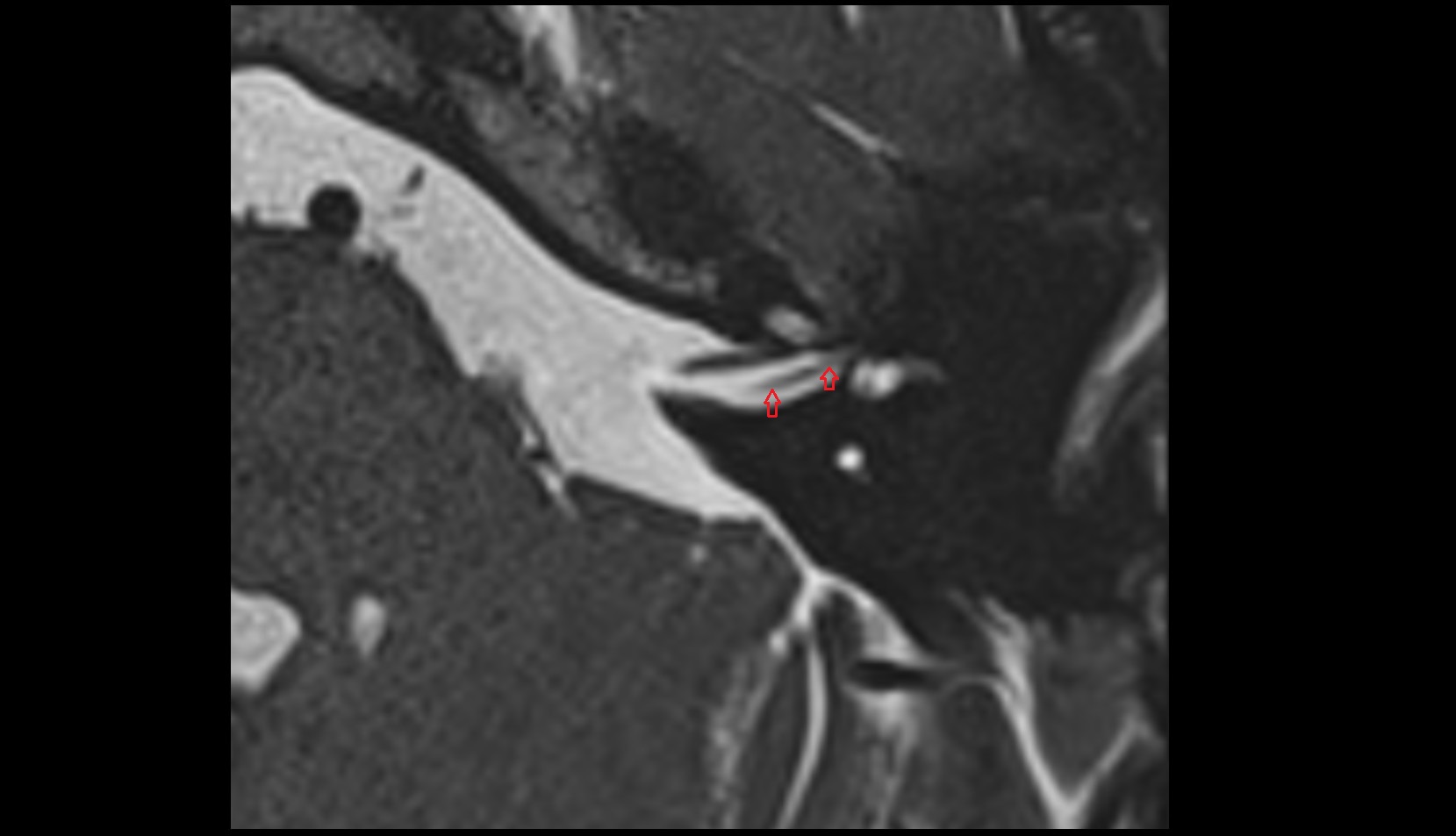 Superior vestibular nerve mri axial image