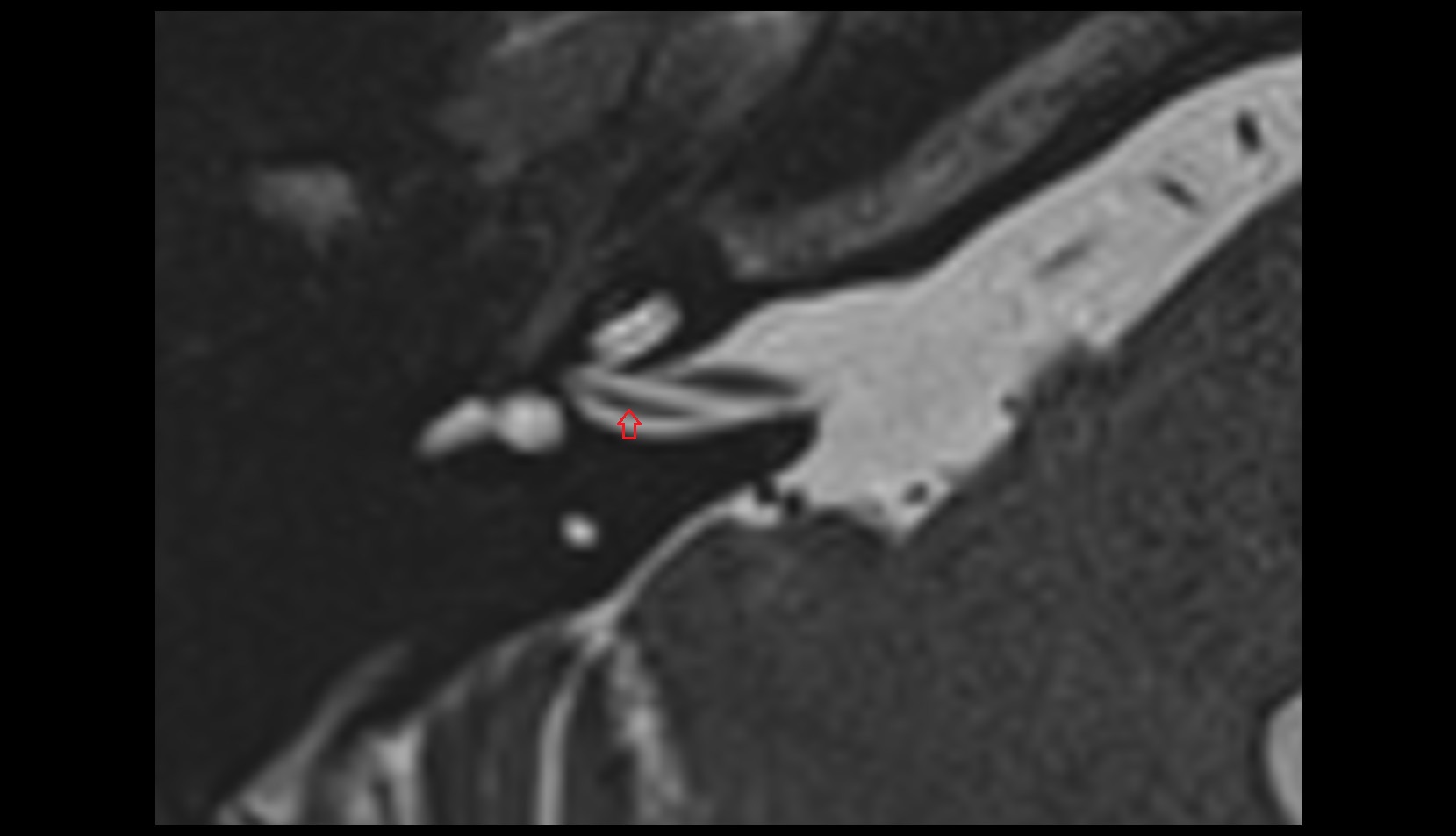 Superior vestibular nerve mri axial image 1