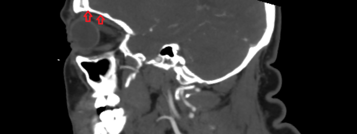 Superior wall of orbit CT  anatomy labelled image-img-00000-00000