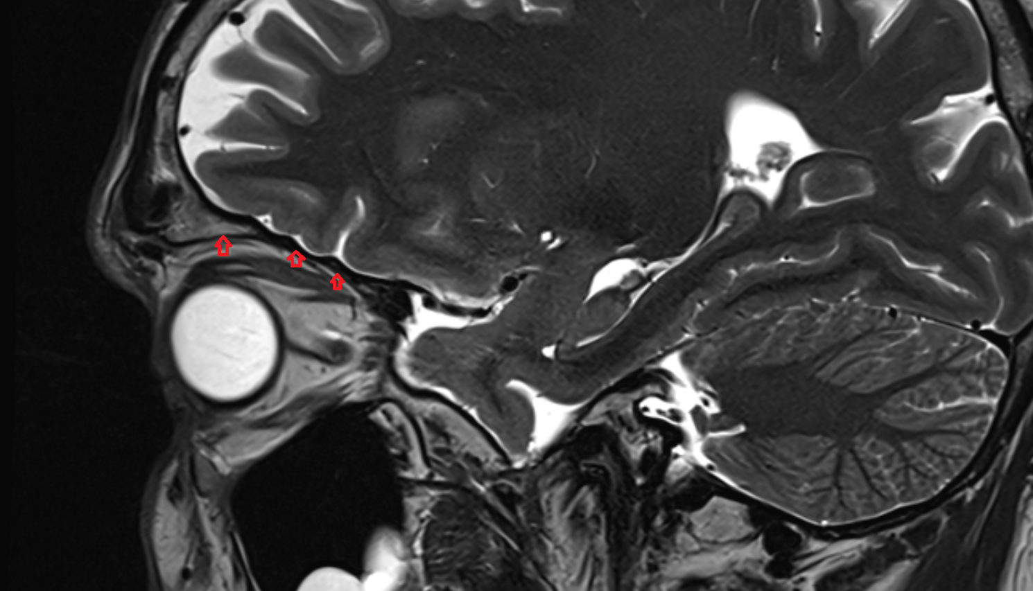 Superior wall of orbit MRI  anatomy labelled image-img-00000-00000