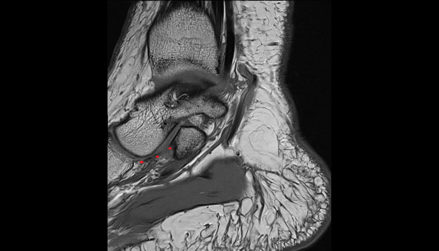 Superomedial calcaneonavicular ligament sagittal cross sectional anatomy 3T MRI AI enhanced radiology image-img-00000-00000