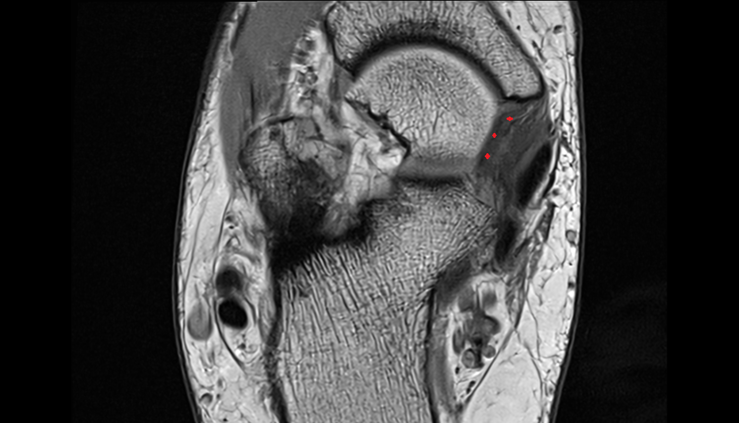 Superomedial calcaneonavicular ligament (spring ligament complex) axial cross sectional anatomy 3T MRI AI enhanced radiology image-img-00000-00000
