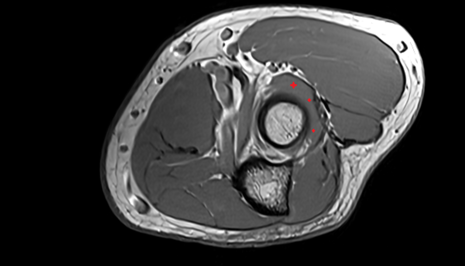 Supinator muscle  axial cross sectional anatomy 3T MRI AI enhanced radiology image -img-00000-00000