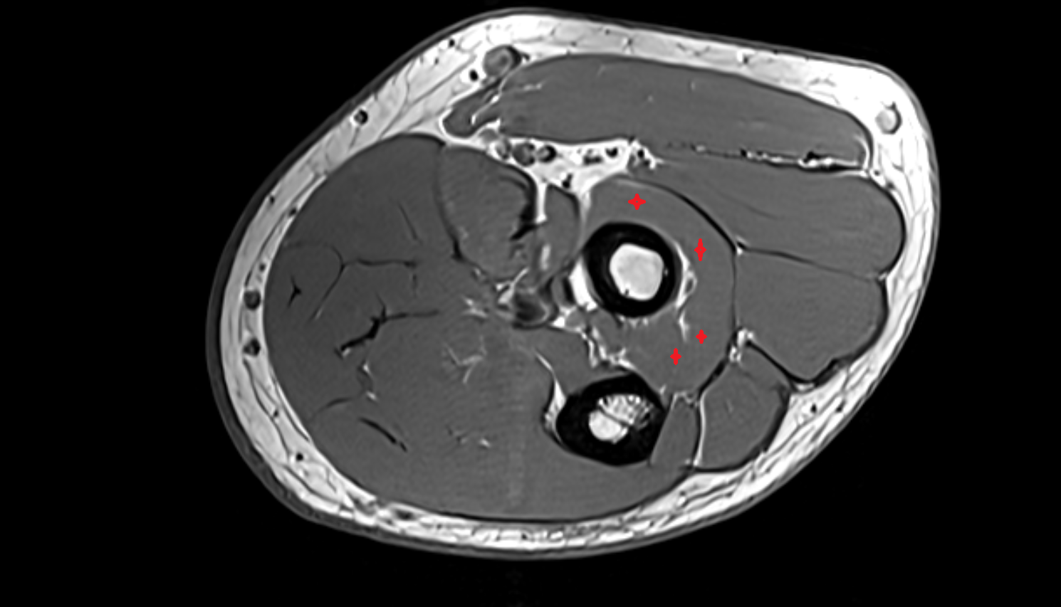 Supinator muscle  axial cross sectional anatomy 3T MRI AI enhanced radiology image -img-00000-00000_00002