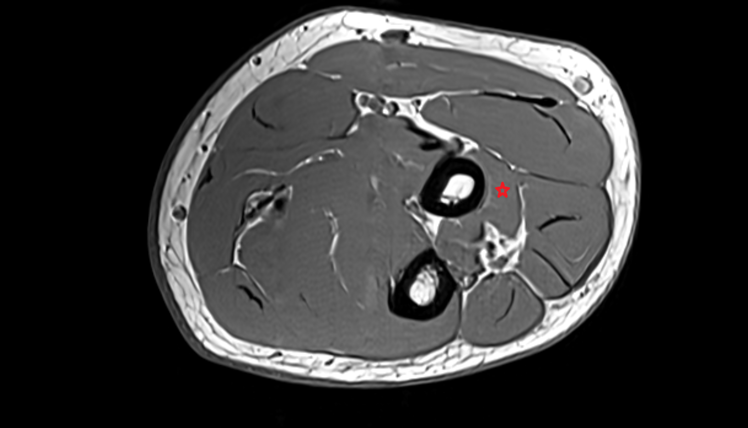 Supinator muscle  axial cross sectional anatomy 3T MRI AI enhanced radiology image -img-00000-00000_00003