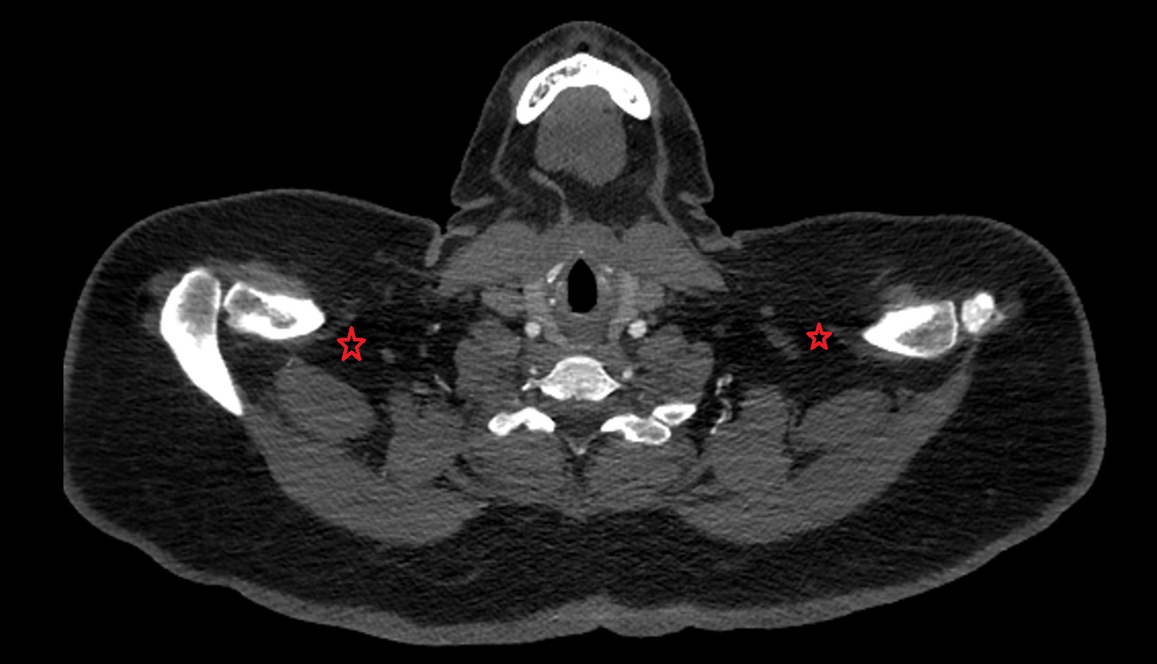 Supraclavicular fossa ct axial