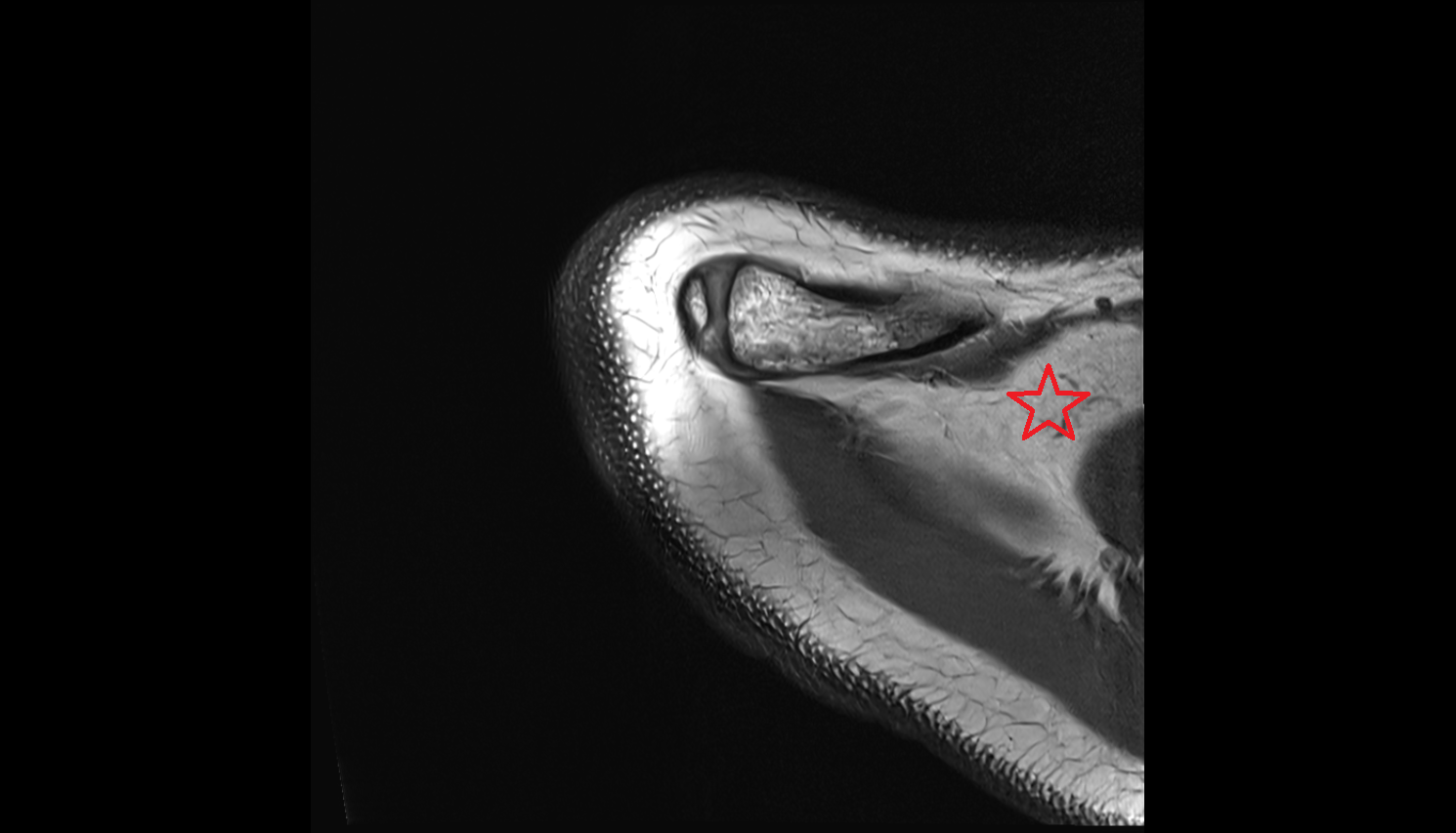 Supraclavicular fossa  shoulder axial cross sectional anatomy 3T MRI AI enhanced radiology image-img-00000-00000