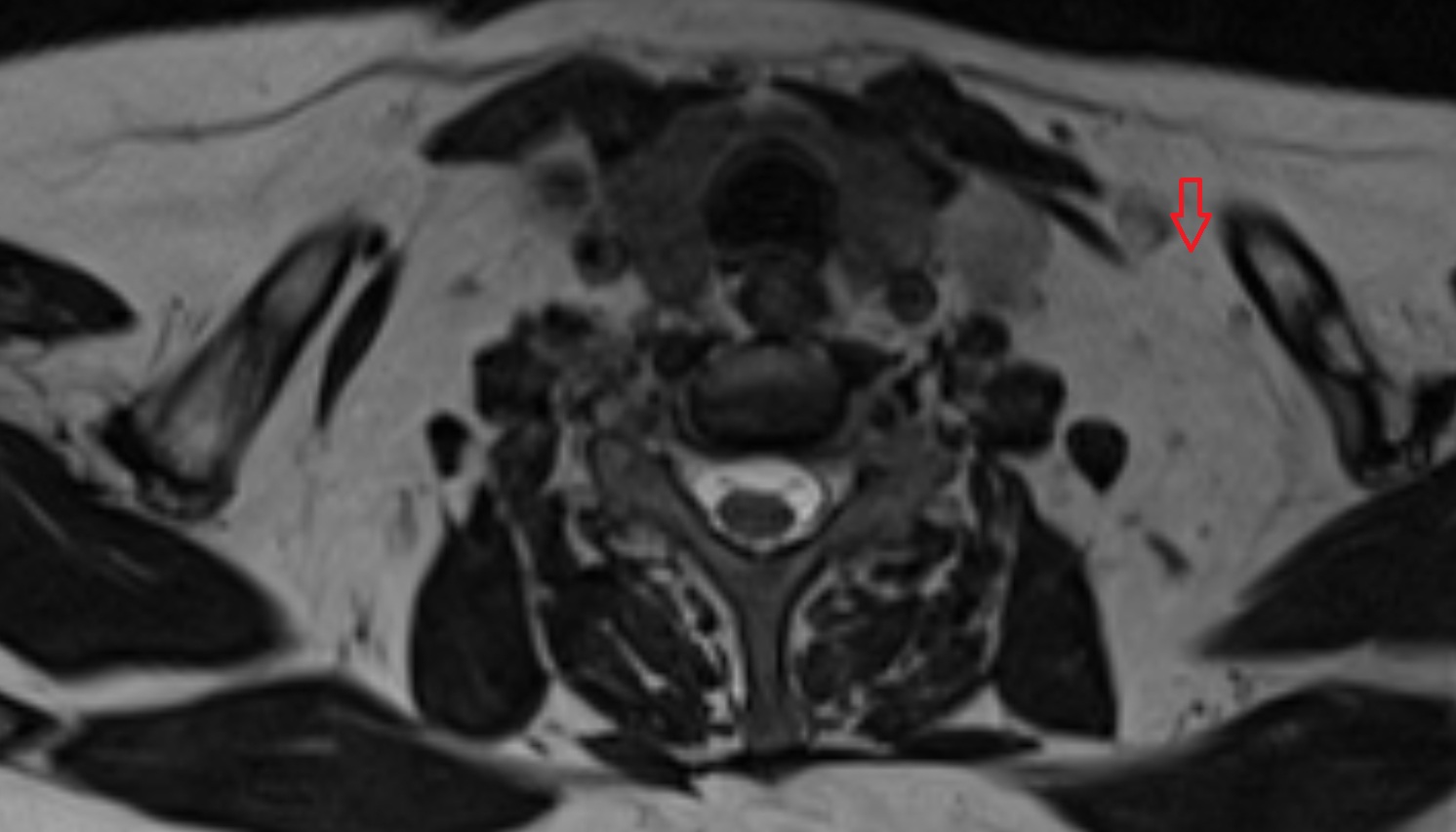Supraclavicular lymph nodes  mri axial  image -img-00000-00000
