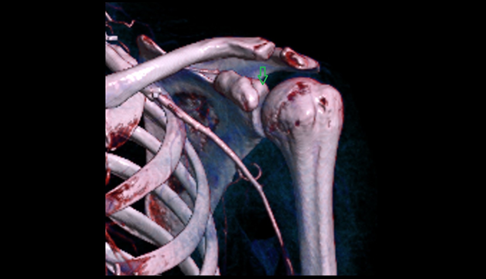 Supraglenoid tubercle