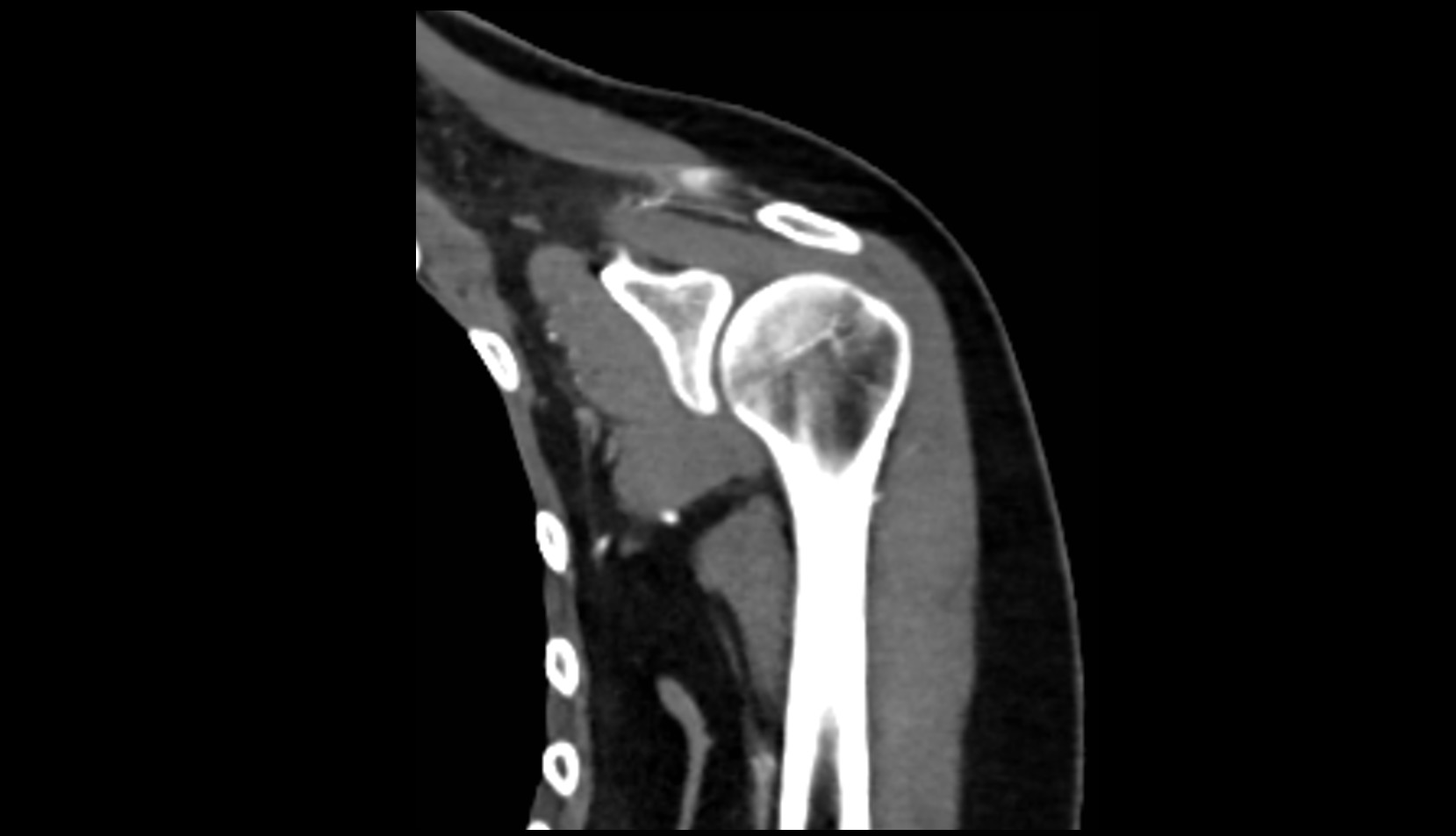 Supraglenoid tubercle ct