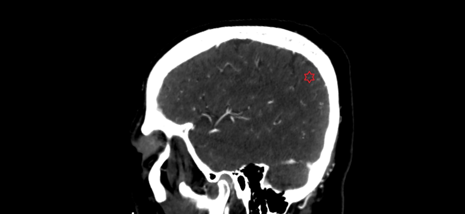 Supramarginal gyrus CT sagittal  cross sectional anatomy radiology image -img-00001-00001