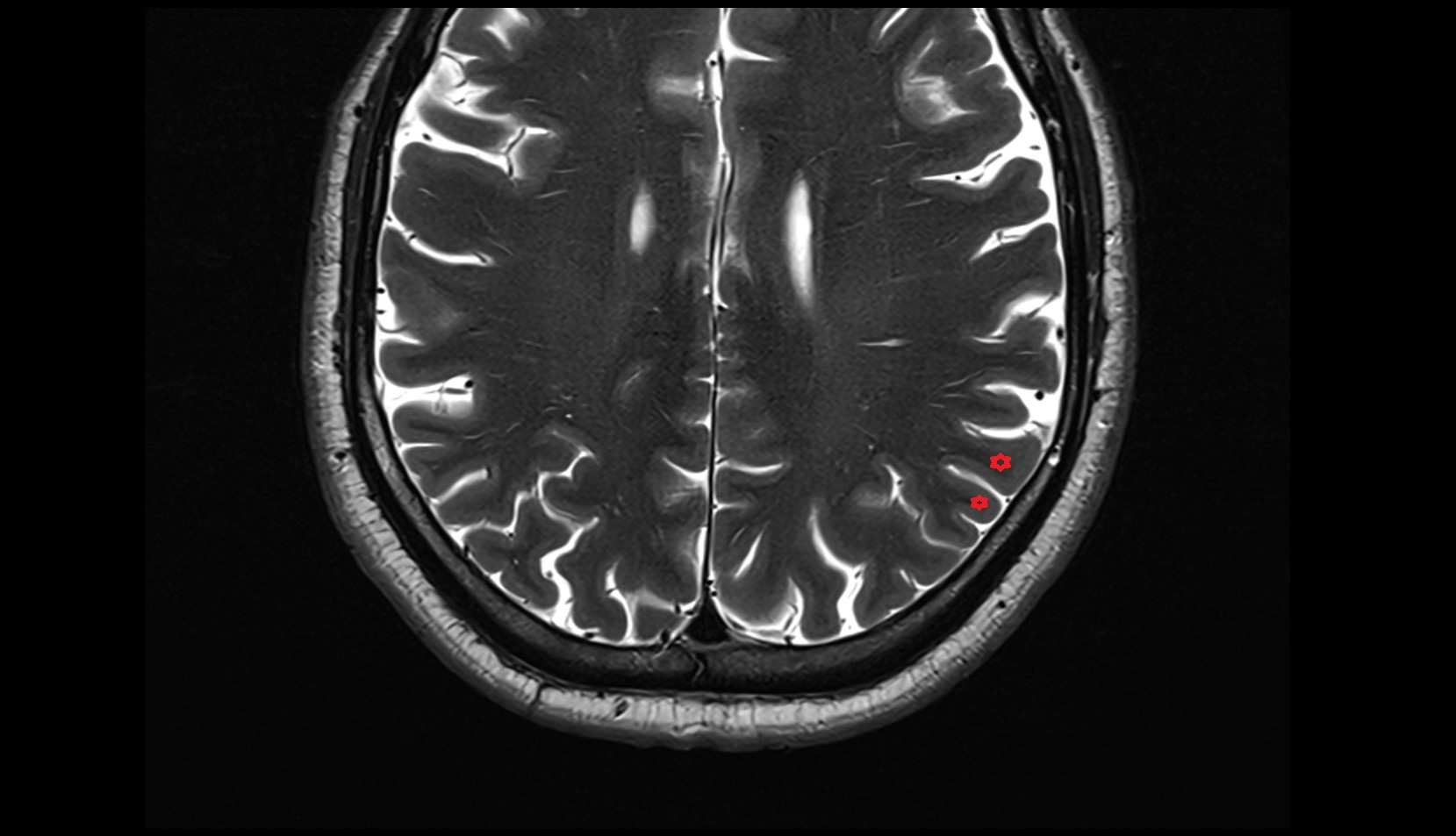 Supramarginal gyrus MRI 3t axial image